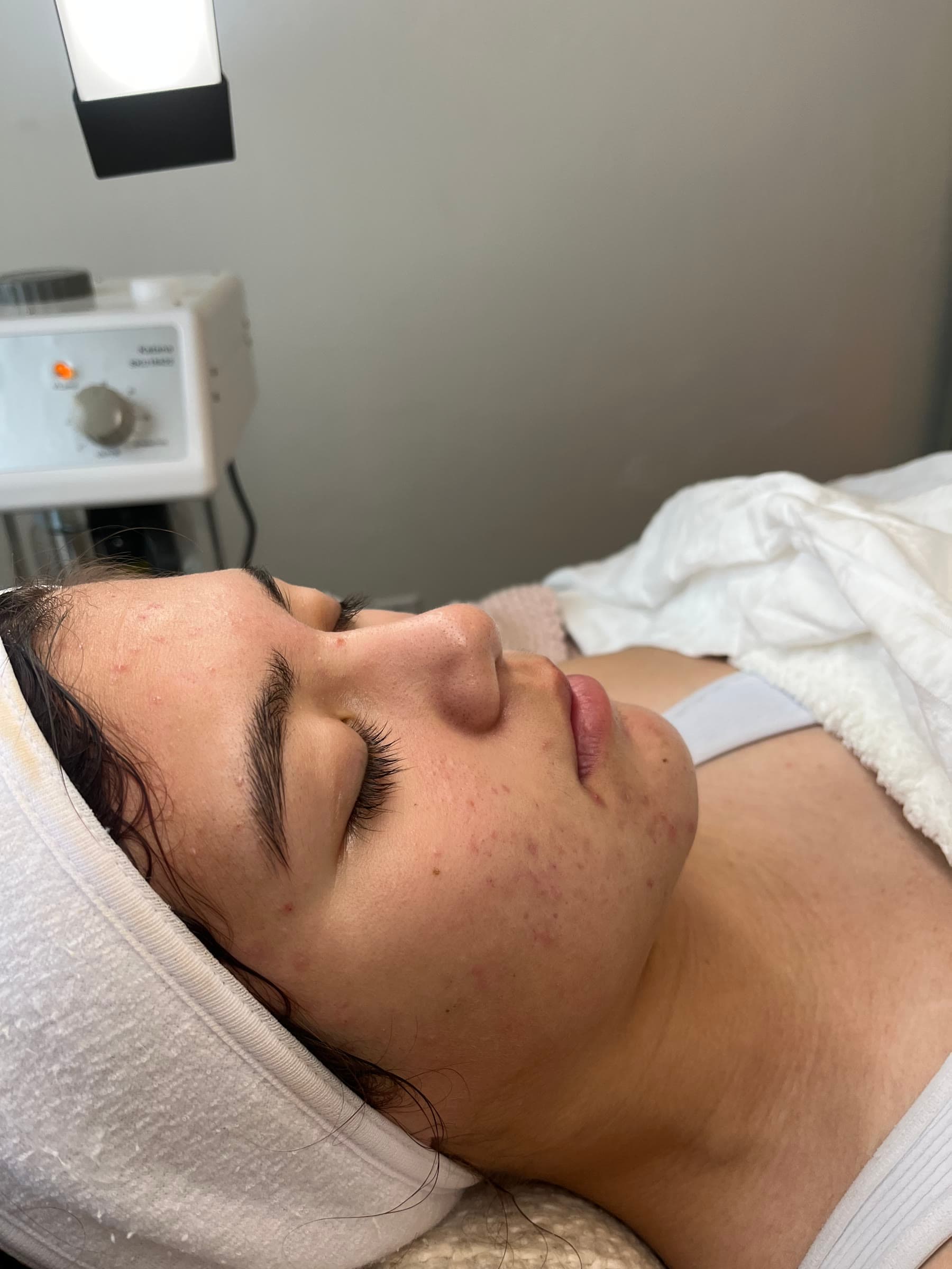 Client skin before the Acne Clarity Program